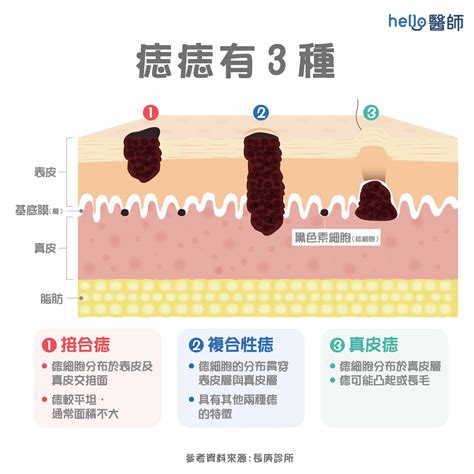 陰莖痣